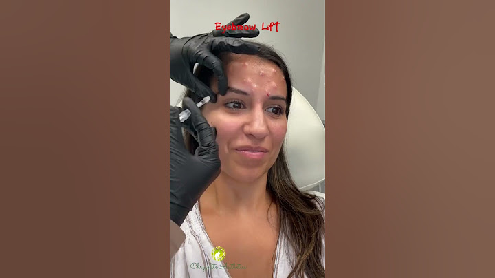 Botox for upper face