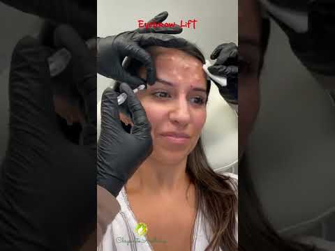 Video: Mal by som mať na aplikácii botox make-up?