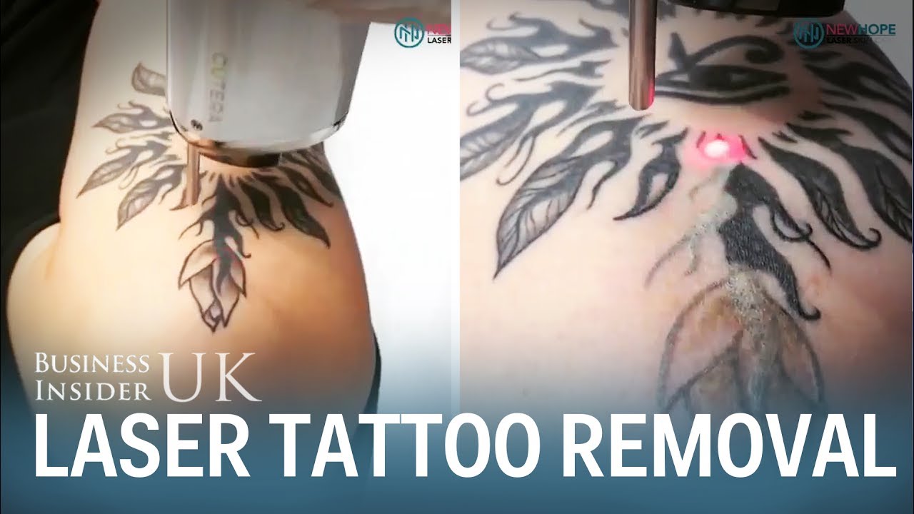 Laser Tattoo Removal