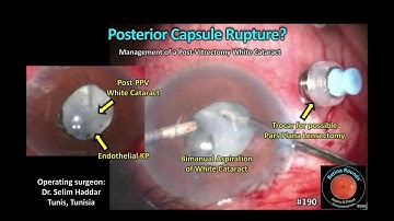 RetinaRounds™ 190: Schending van het achterste kapsel?