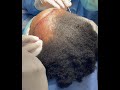 African American Female FUT Hair Transplant