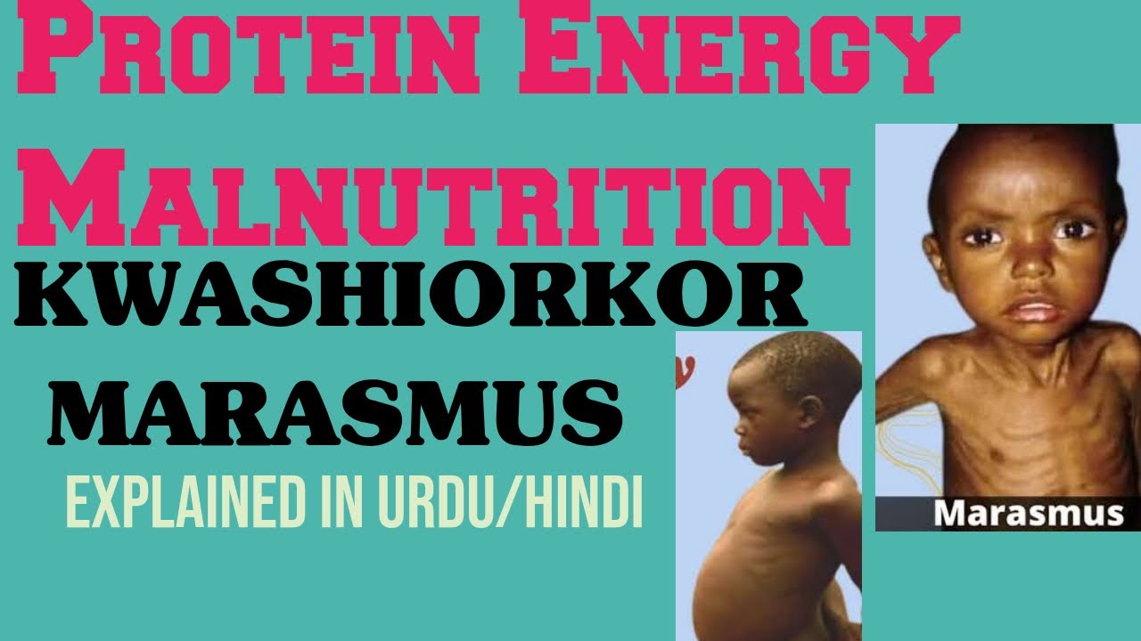Protein Energy Malnutrition Kwashiorkor And Marasmus Explained In Easy