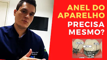 Para que serve o anel do aparelho?