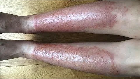 Jaké jsou skvrny na rukou a nohou?