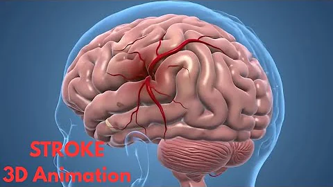 Understanding The Different types of Stroke | 3D Animation | In Hindi 