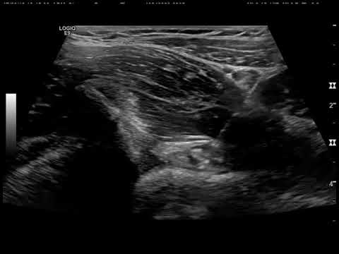 Pain left hip and groin - Injection CAM diagnostic blocked