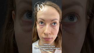 До и После нижней блефаропластики 👉 #пластическийхирургмосква