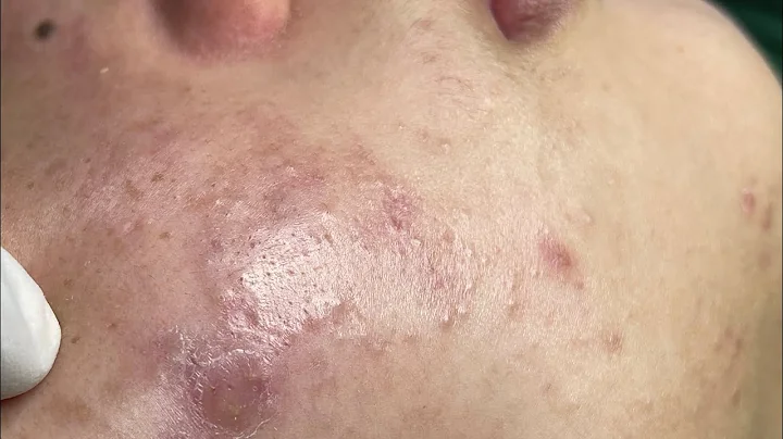 Relaxing Acne Treatment #119(Linh My Dang)