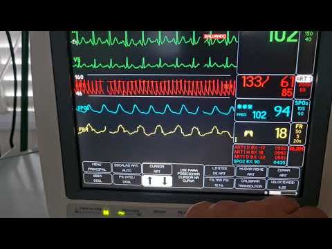 Vídeo: Pressão De Pulso: Calculadora, Variação E Muito Mais