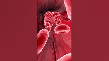 DVT का सही ईलाज क्या है? DVT treatment option by Dr. Amol Lahoti