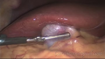 Gallbladder removal surgery