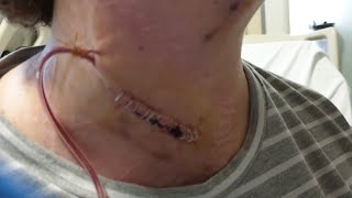 1st Update after ACDF procedure.  2 weeks post op. UK Surgery