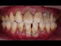 Say bye to tartar! | Dentist | Dokter Gigi Tri Putra