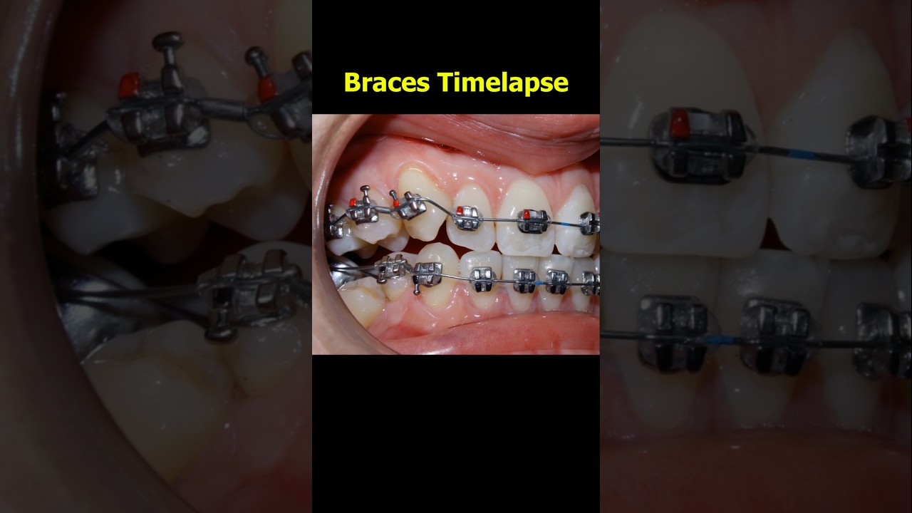 Braces process timelapse. Fix crooked teerh 26 months duration #braces #orthodontist #teeth #dentist