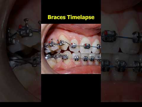 Braces process timelapse. Fix crooked teerh 26 months duration #braces #orthodontist #teeth #dentist