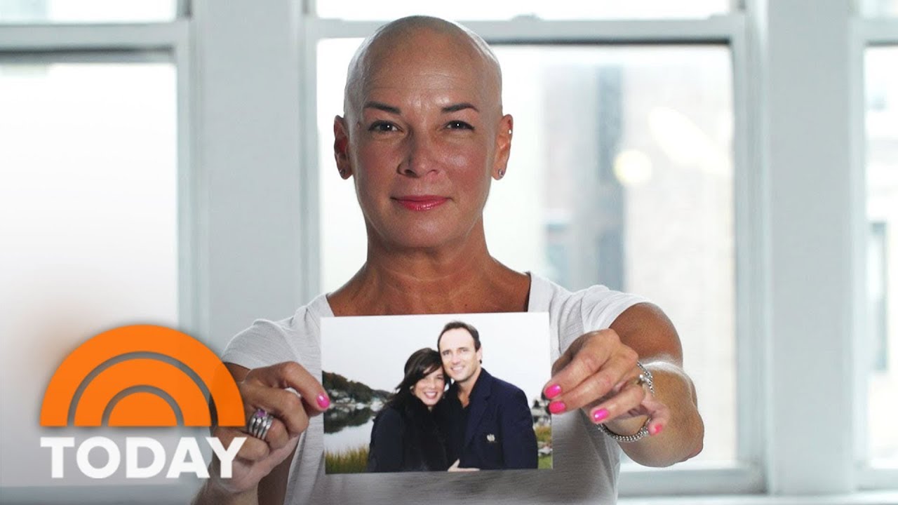 Women Reveal What Its Like To Experience Permanent Hair Loss  TODAY