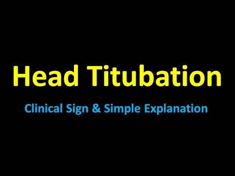 Head Titubation| Clinical Sign | Simple Explanation | Neurology
