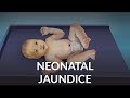 Neonatal jaundice by lauren veit for openpediatrics