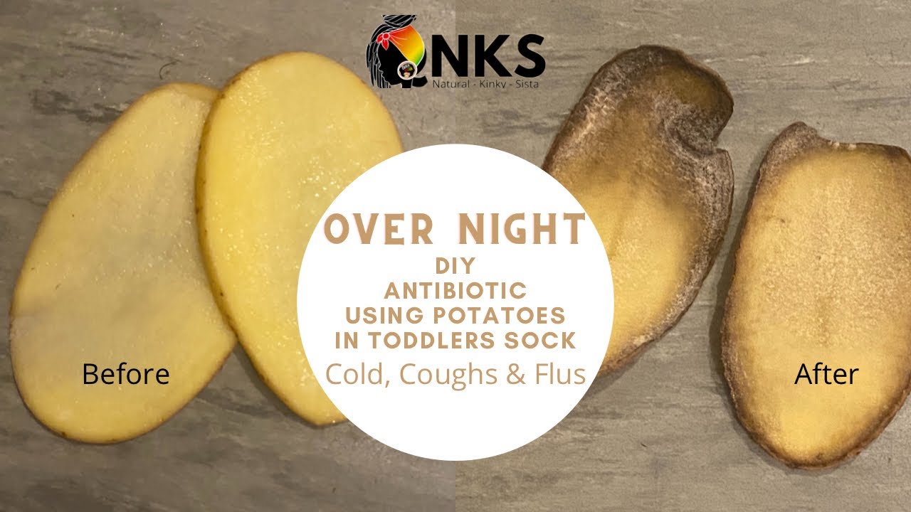 Using Potatoes to treat Coughs and colds toddlers best remedy! Sock