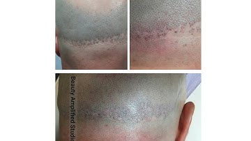 Covering Hair Transplant Scars with Scalp Micropigmentation (SMP)
