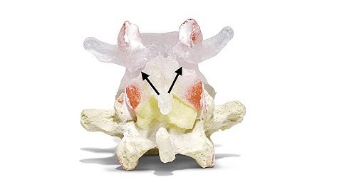 Spondylolytic Spondylolisthesis Dynamic Disc Model