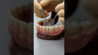 Hidden Decay Between Teeth Exposed - Interproximal Caries #shorts