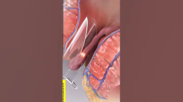 علاج البواسير 