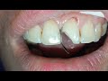 Broken tooth fillingshorts