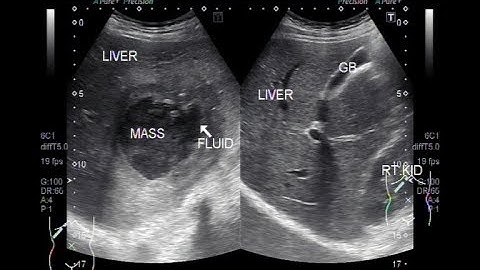 Ultrasound Video showing Amoebic liver abscess.