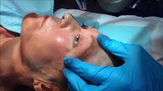 Ron Shelton, MD - Fraxel Treatment
