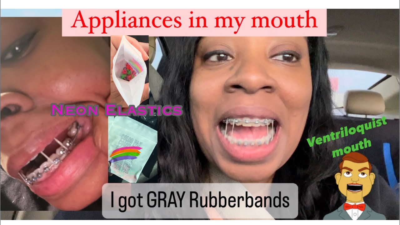 Braces Update Ventriloquist Mouth Finishing Wires Neon Elastics 👄
