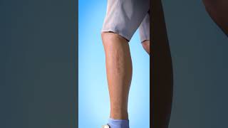 How Stitches Work in Human Skin 🩹 | Healing Process Explained