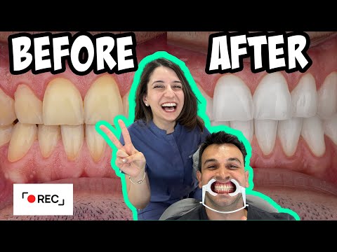 Diş Beyazlatma İşlemi Nasıl Yapılır ? |  \