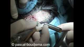 New Direct FUE technique invented by Dr Boudjema - Paris - France