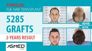 Manual FUE Hair Transplant Result 5285 Graft 2 Years #hairtransplant #saçekimi