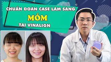 #Case 21: Điều Trị Răng Móm Bằng Khay Niềng Răng Trong Suốt
