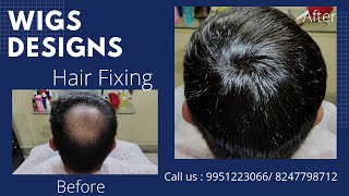 Hair Patch Clipping / Hair Fixing in Hyderabad and Bangalore | 9951223066 / 8247798712