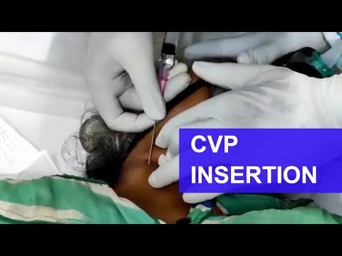 #CVP insertion (right #IJV) #central line insertion