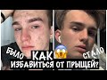 КАК ИЗБАВИТЬСЯ ОТ ПРЫЩЕЙ? | плюс мой уход за кожей и волосами