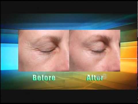 laser aging devices anti