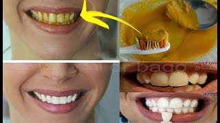 صدق او لا تصدق تبييض الاسنان في ربع ساعة بطريقة بسيطة جدا و غير مكلفة ازالة جير الاسنان و التسوس