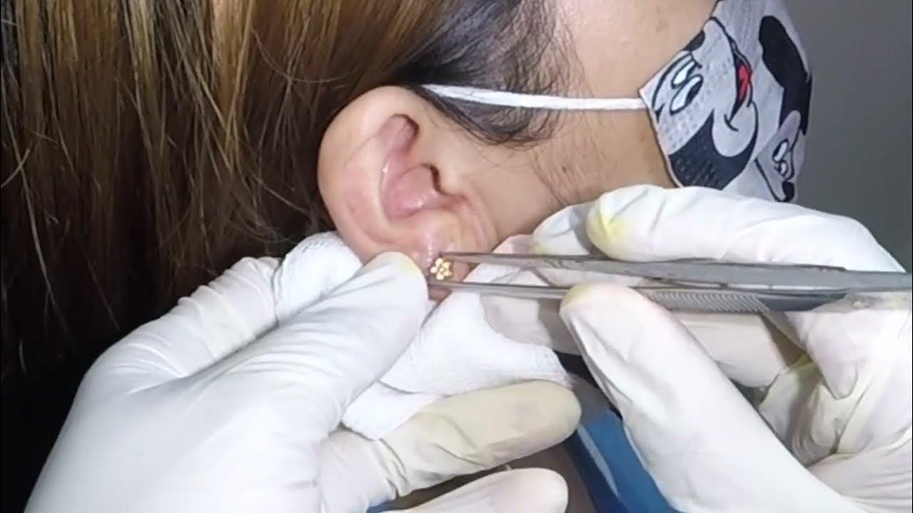 How to Remove an Earring Stuck in Woman's Earlobe YouTube