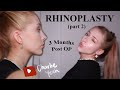 3 MONTH UPDATE | My Nose Job Experience | Healing from Rhinoplasty | My Nose Job in Australia