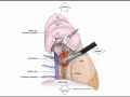 VATS Lobectomy Illustrated by Blackmon for STS