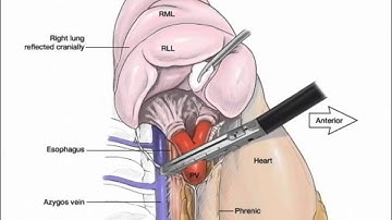 VATS Lobectomy Illustrated by Blackmon for STS
