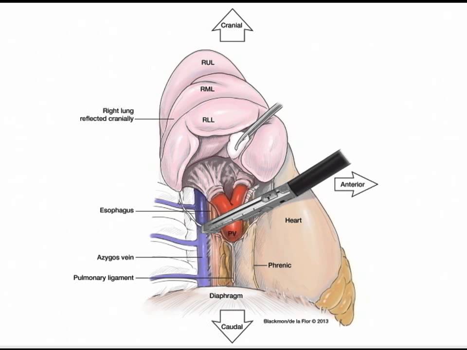Download VATS Lobectomy Illustrated by Blackmon for STS