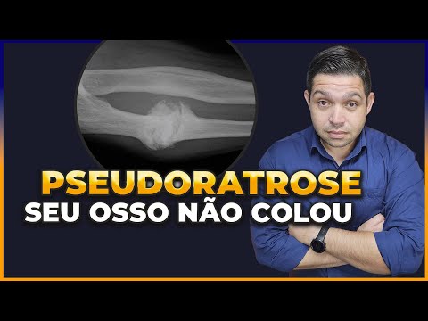 PSEUDOARTROSE | OSSO