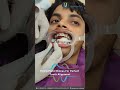 Orthodontic Treatment - Fixing Metal Braces For Perfect Tooth Alignment | Tooth Journey