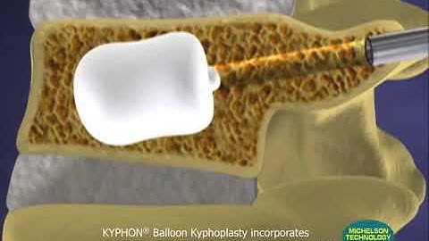 Balloon Kyphoplasty Animation