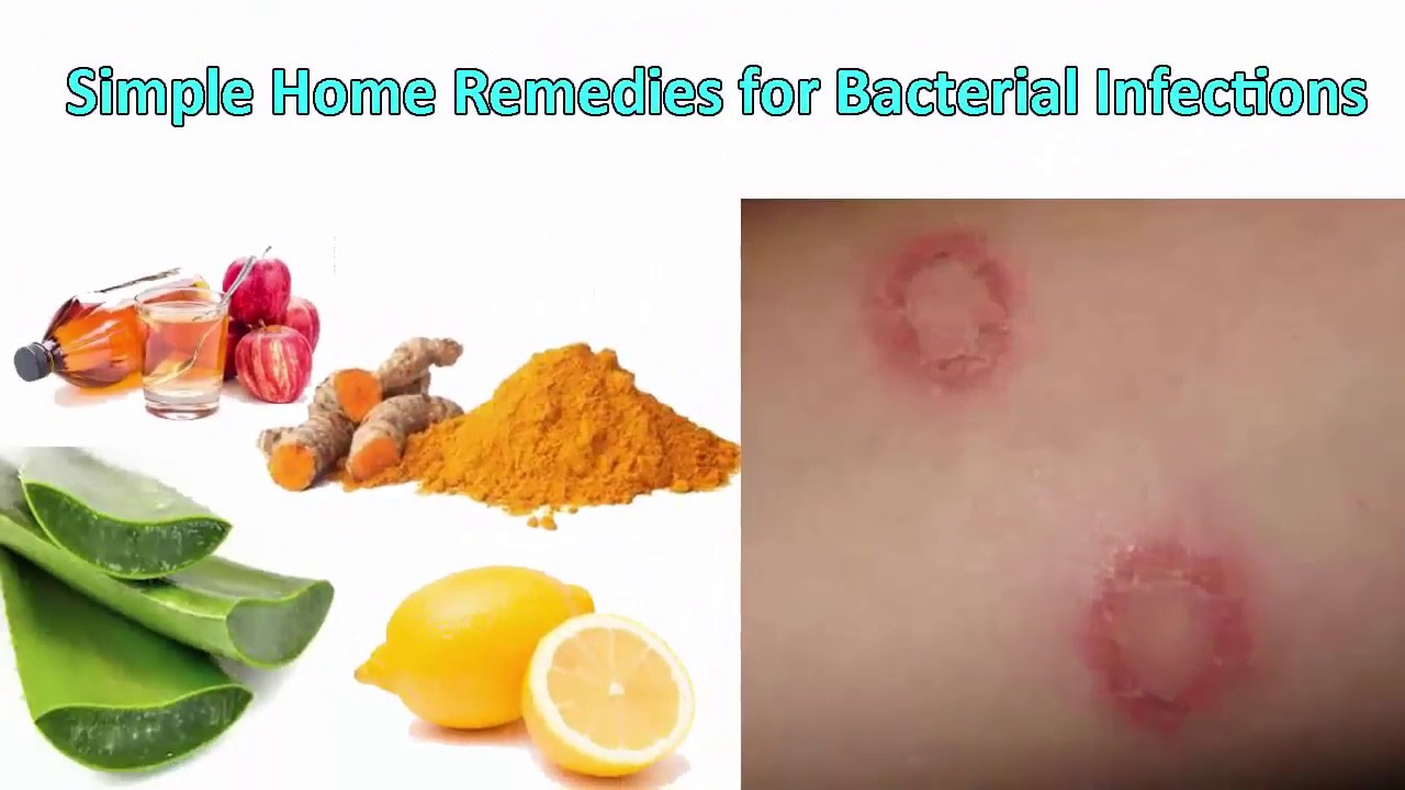 5 Simple Home Remedies For Bacterial Infections Bacterial Infection